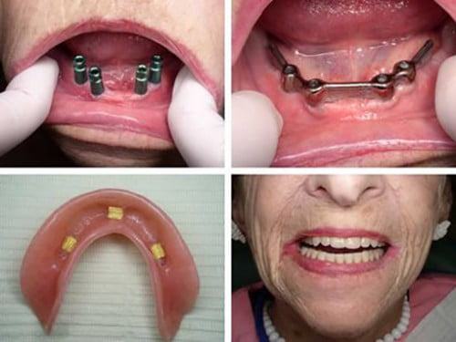 Tìm hiểu về kĩ thuật làm răng Implant 2