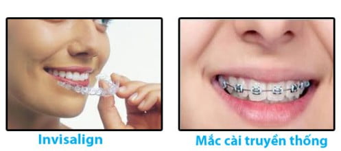 Niềng răng là giải pháp nha khoa tiên tiến 3