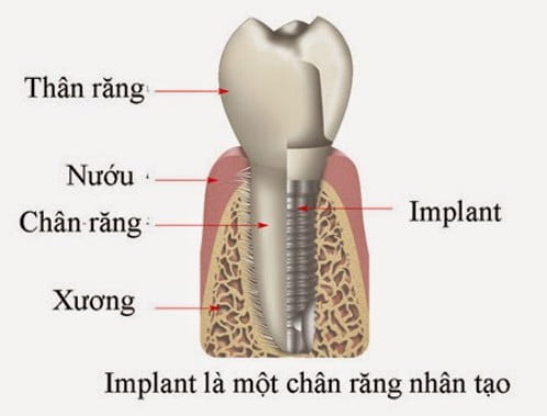 Cấy ghép Implant ngay sau khi nhổ răng 1