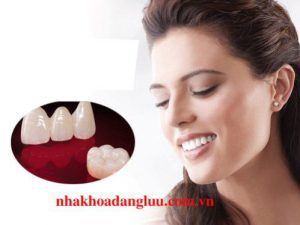 Ưu điểm răng sứ Veneer là gì ?