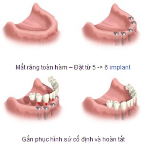 Giá làm răng implant 1