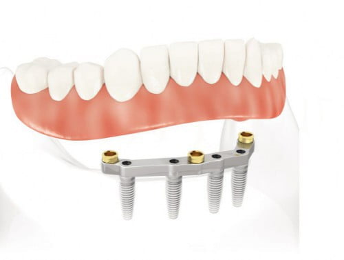 Chi phí trồng răng implant 2
