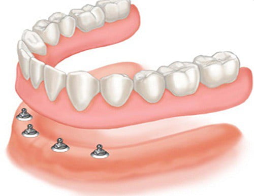 Ưu nhược điểm của các phương pháp trồng răng giả 2