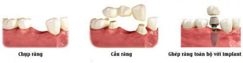 Trồng răng giả cố định gồm những loại nào? 1