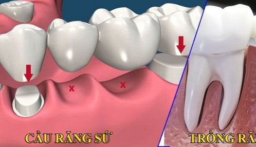 Cấy ghép răng implant có hiệu quả không ? 1