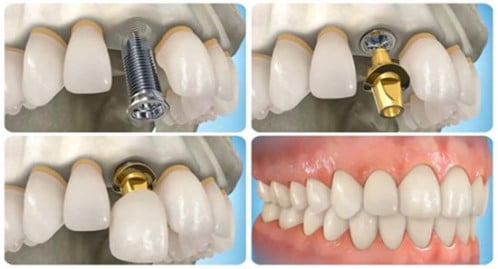 Sâu răng có nên cấy ghép Implant không  2