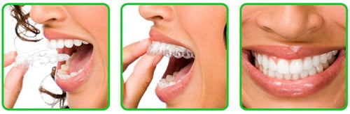 Phương pháp niềng răng không mắc cài 3D Clear 2
