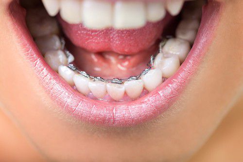 Mắc cài niềng răng có tác dụng gì? 3