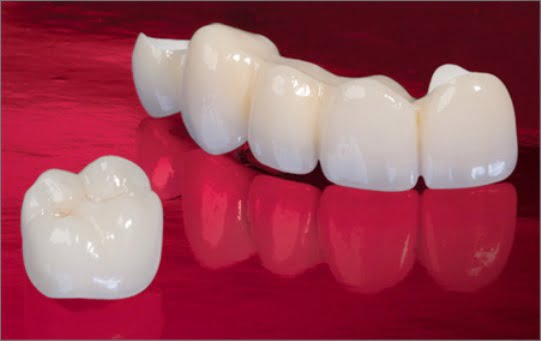 Răng toàn sứ venus có hiệu quả gì?