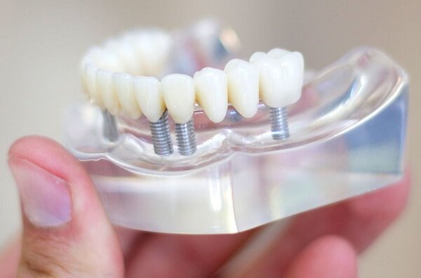 Bọc răng sứ cho răng bị ố vàng