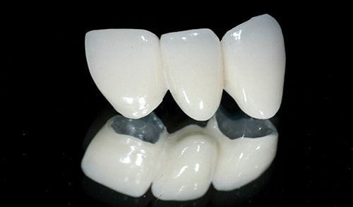 Hiệu quả của bọc răng sứ Cercon