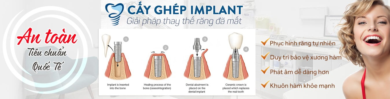 Các bước thực hiện trồng răng implant 1