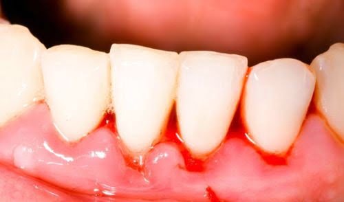 Cạo vôi răng có đau không?