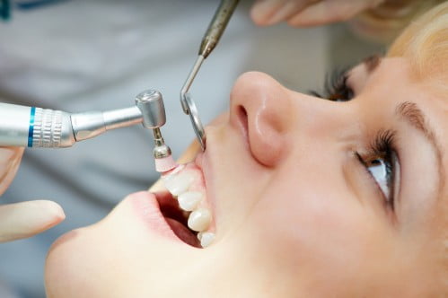Cạo vôi răng mất bao lâu thời gian?