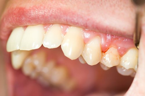 Có nên cạo vôi răng không? Có ảnh hưởng gì không? Có nên cạo vôi răng không? Có ảnh hưởng gì không?
