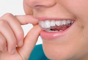 Hướng dẫn sử dụng thuốc tẩy trắng răng tại nhà