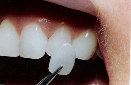 Bọc răng sứ không cần mài răng bạn đã biết?      