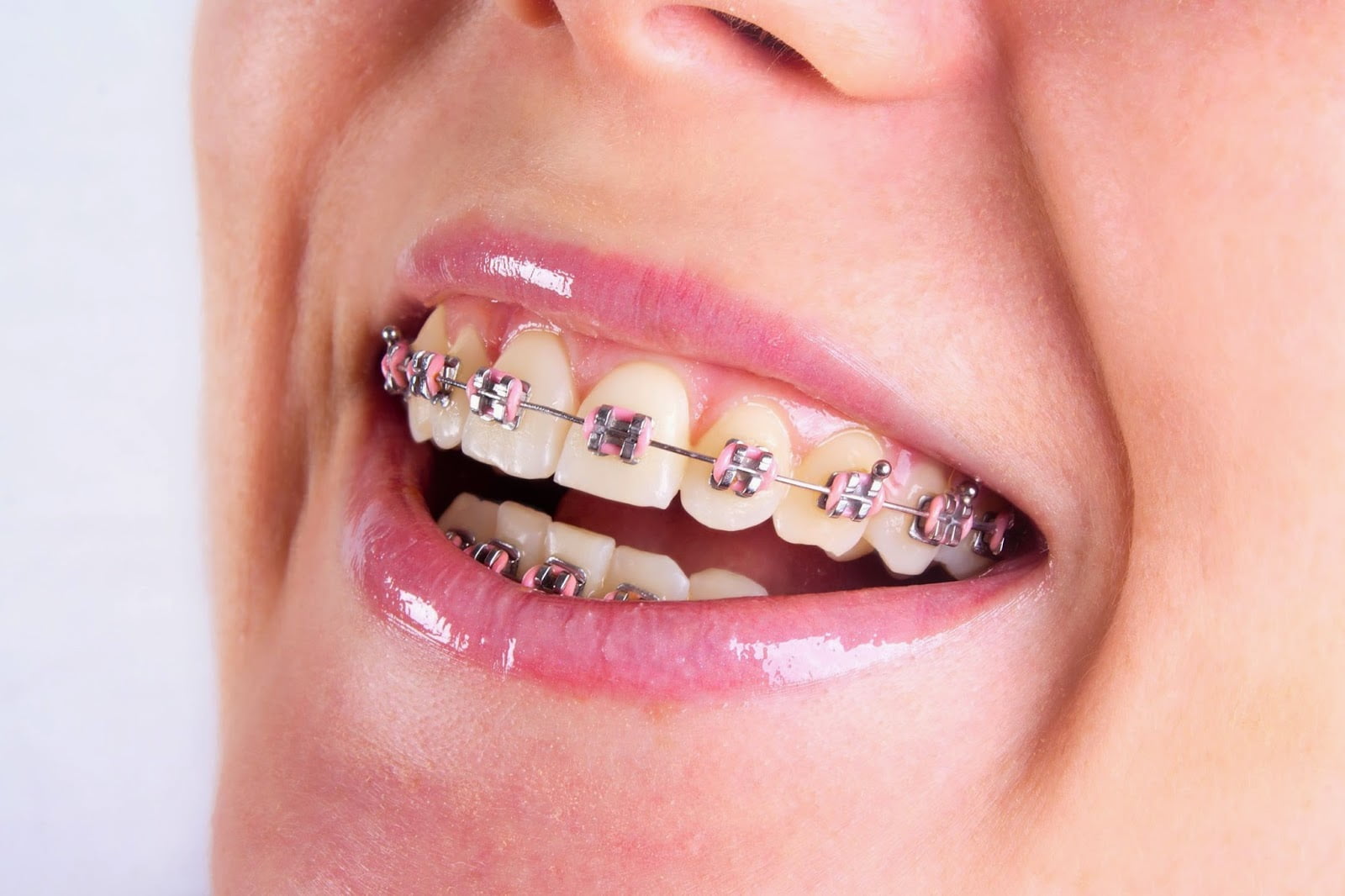 Niềng răng cửa bị mọc lệch Niềng răng cửa bị mọc lệch