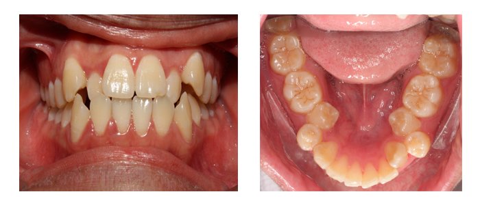 Niềng răng lệch lạc 1 Niềng răng lệch lạc 1