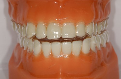 Niềng răng tháo lắp là gì? Giá bao nhiêu tiền? Niềng răng tháo lắp là gì? Giá bao nhiêu tiền?