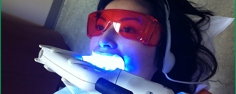 Quy trình tẩy trắng răng bằng laser như thế nào?