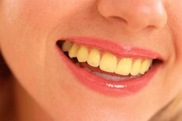 Răng bị vàng có tẩy trắng được không 1
