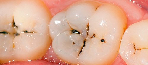 Răng bị vàng có tẩy trắng được không?