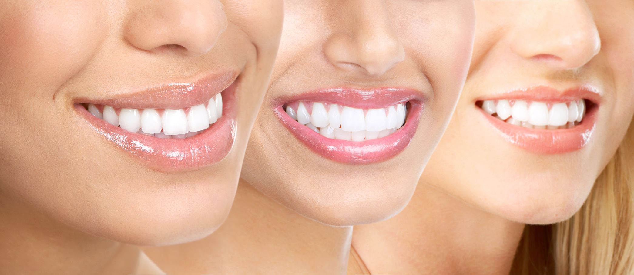 Sau khi tẩy trắng răng không nên ăn gì?