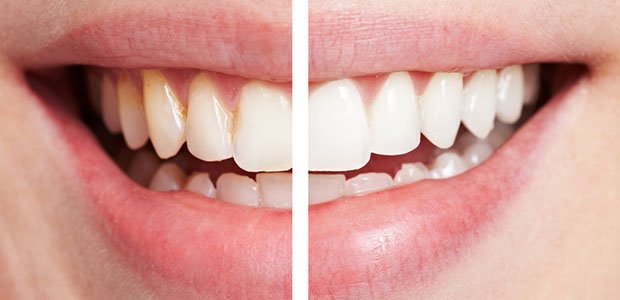 Tẩy trắng răng bằng laser bao nhiêu tiền?