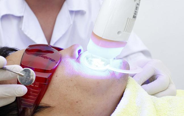 Tẩy trắng răng an toàn bằng phương pháp nào? 3