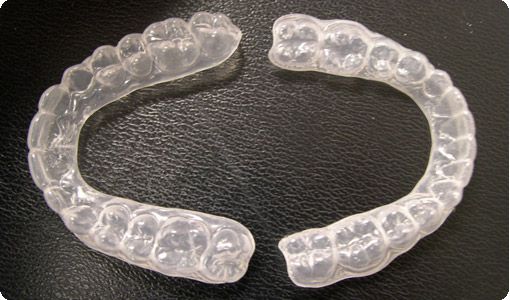 Tẩy trắng răng duy trì được trong bao lâu? 2