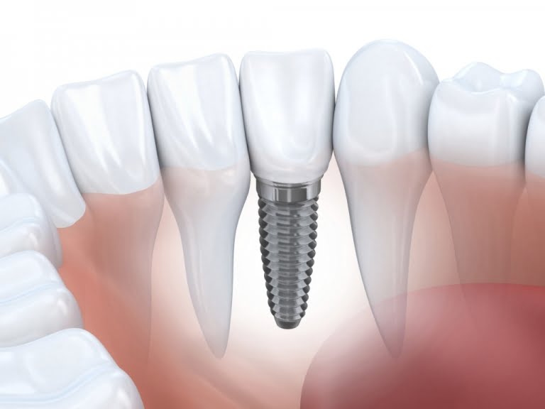 Cấu tạo của răng Implant nha khoa 3