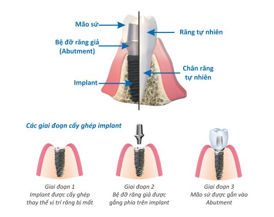 Cấu tạo của răng Implant nha khoa 2