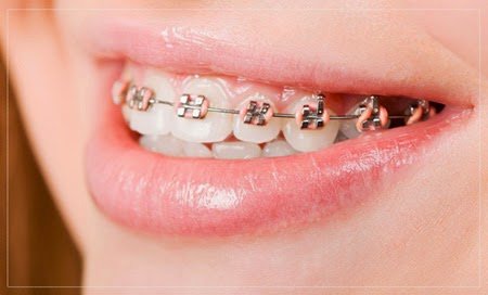 Có nên chọn niềng răng tại nha khoa Đăng Lưu? 1