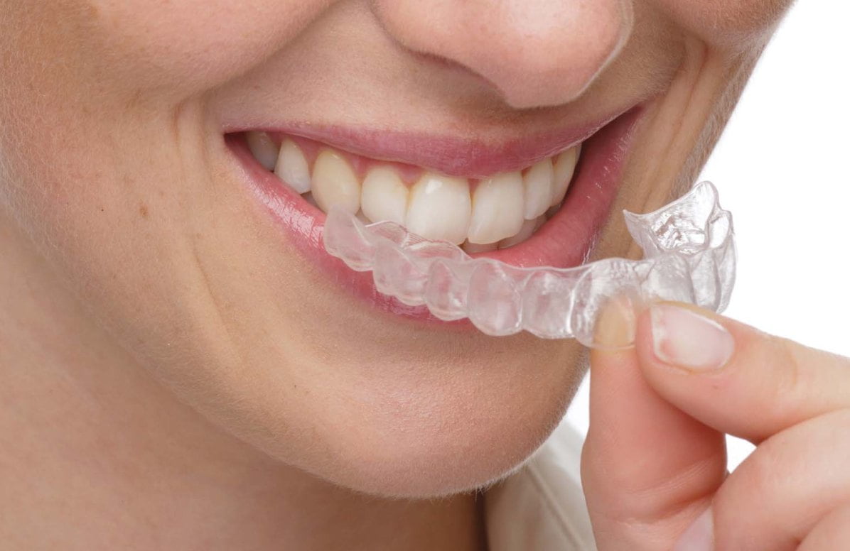 Niềng răng không mắc cài Clear Aligner Niềng răng không mắc cài Clear Aligner