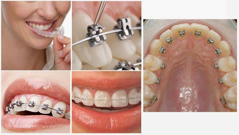 Kiến thức cơ bản về niềng răng thẩm mỹ 3