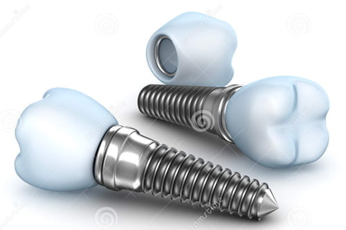 Trồng răng implant có bền chắc không ?