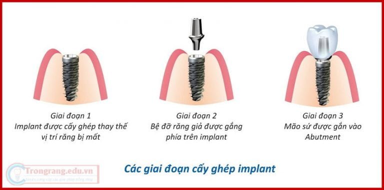 Hiệu quả của cấy ghép răng với Implant là gì? 2
