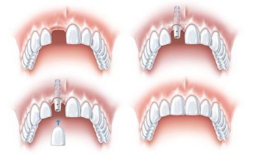 Hiệu quả của cấy ghép răng với Implant là gì? 3