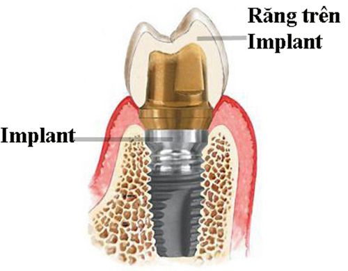 Cấu tạo của răng Implant nha khoa 1