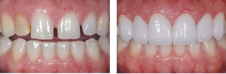 Bọc răng sứ cho răng cửa Bọc răng sứ cho răng cửa