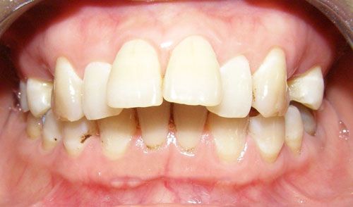 Bọc răng sứ cho răng hô 1