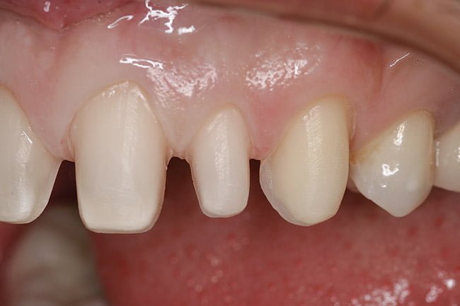 Bọc răng sứ có tác hại gì không ?