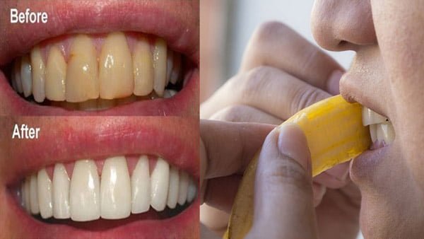 Những cách làm trắng răng hiệu quả 1