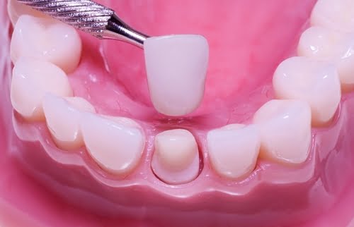 Quy trình bọc răng sứ như thế nào?
