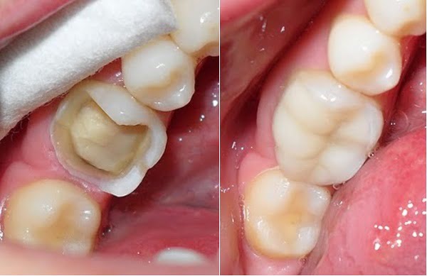 Răng đã lấy tủy có nên bọc răng sứ? Răng đã lấy tủy có nên bọc răng sứ?