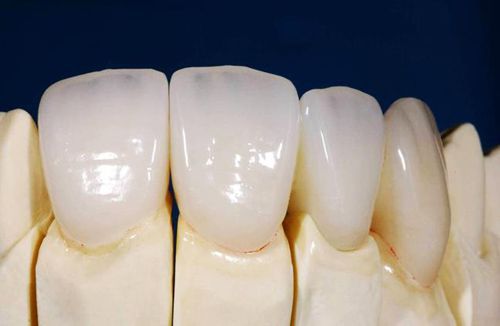 Thông tin hữu ích về bọc răng sứ Cercon 3