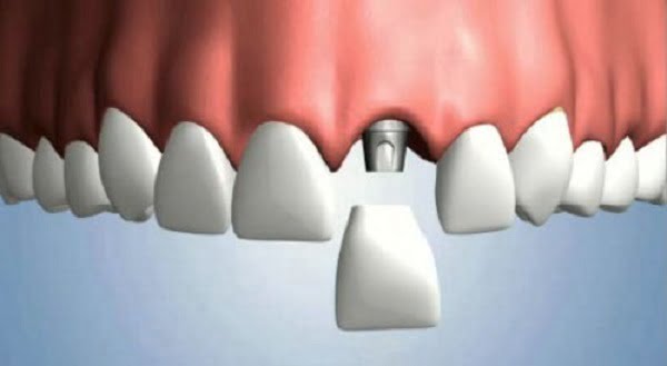 Cắm Implant răng cửa như thế nào? 1