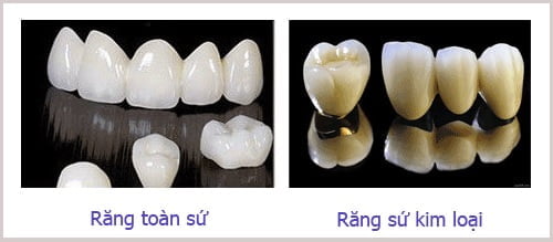 Chi phí trồng răng hàm bao nhiêu tiền?