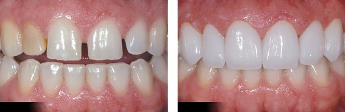 Làm răng sứ veneer nhanh chóng thẩm mỹ Làm răng sứ veneer nhanh chóng thẩm mỹ